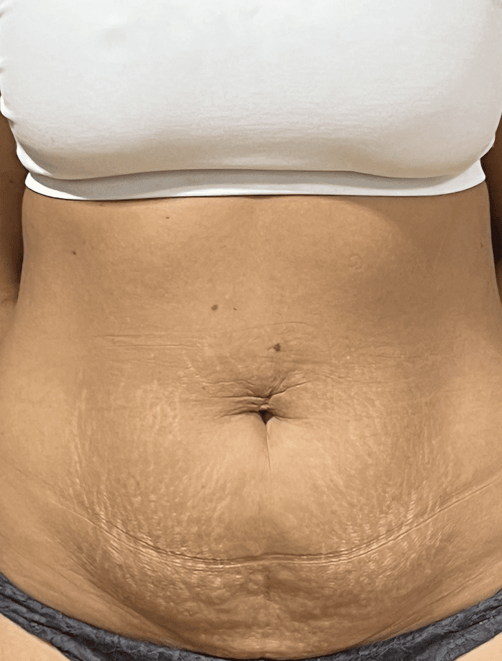 abdominoplasty surgery before image