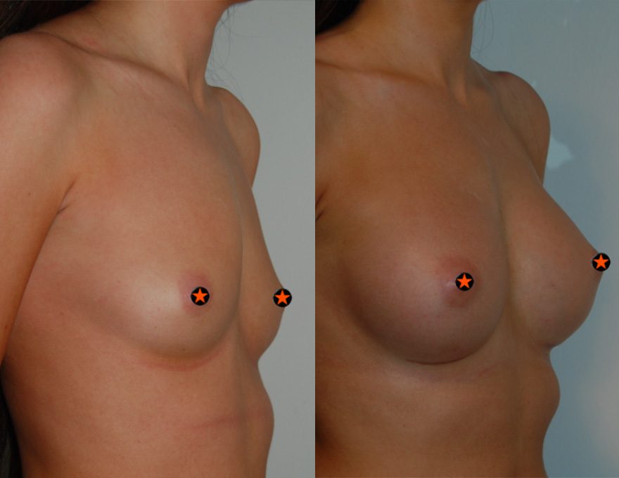 breast augmentation manchester